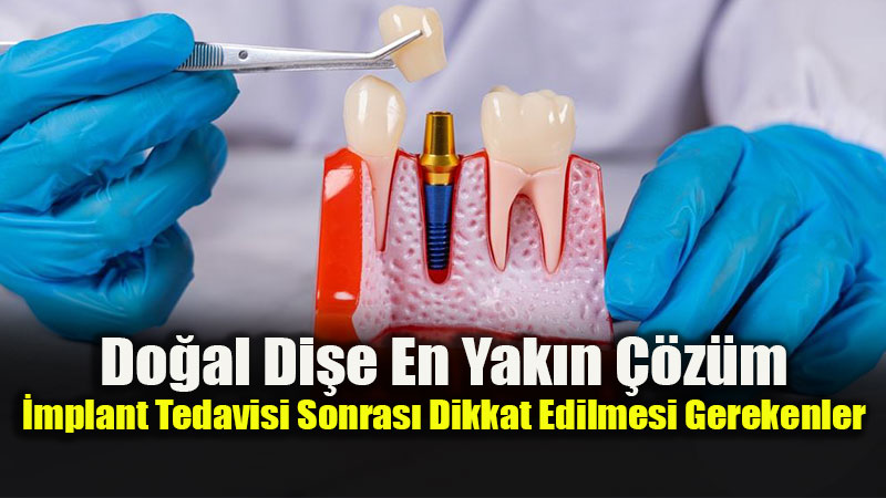 Uzman�ndan �mplant Uyar�s�: A��z Bak�m� Yap�lmazsa Kay�plar Ya�anabilir